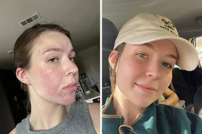 Before and after comparison - 6 Weeks